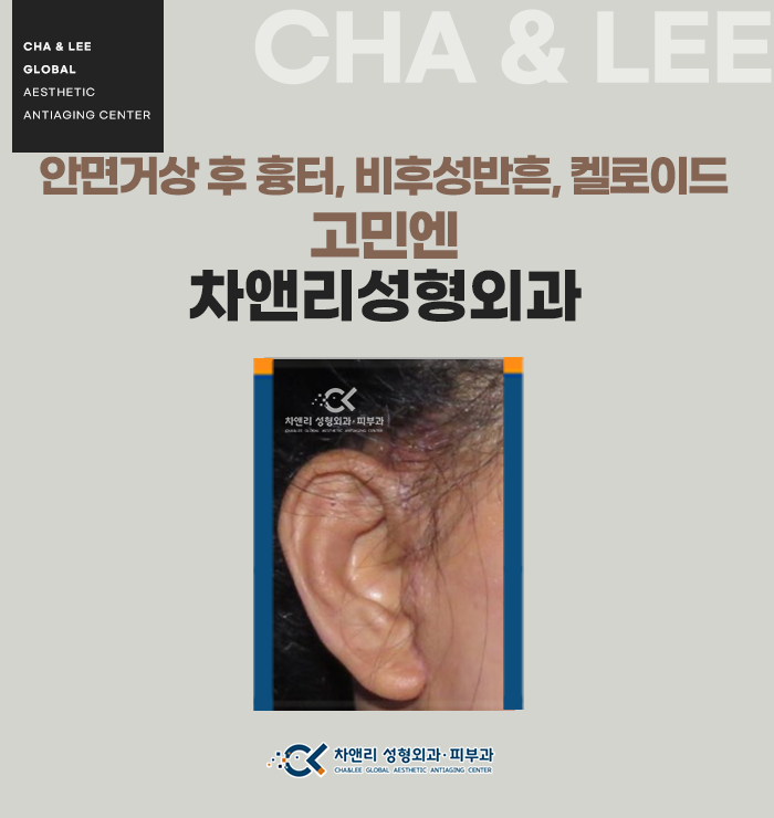  안면거상후 생긴 흉터, 비후성반흔, 켈로이드