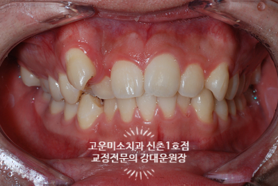  가위교합 거미스마일 덧니 돌출 정중선 쏠림을 동반한 2급부정교합치료 신촌치과 교정전문의 강대운원장 고운미소 신촌1호점 치료증례