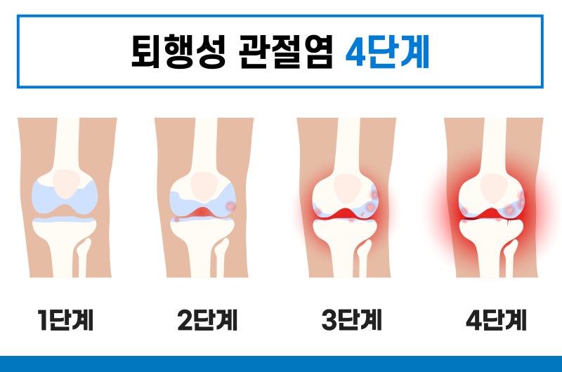 무릎 연골 주사의 효과와 부작용에 대해
