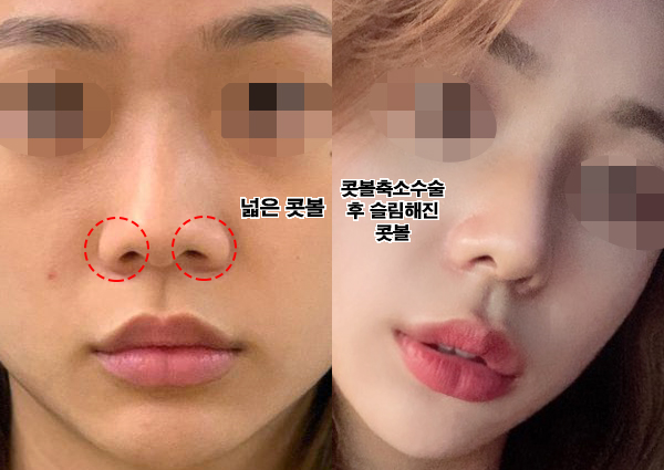  콧볼축소수술, 내 얼굴에 딱 맞는 비율(치유성형외과 후기)