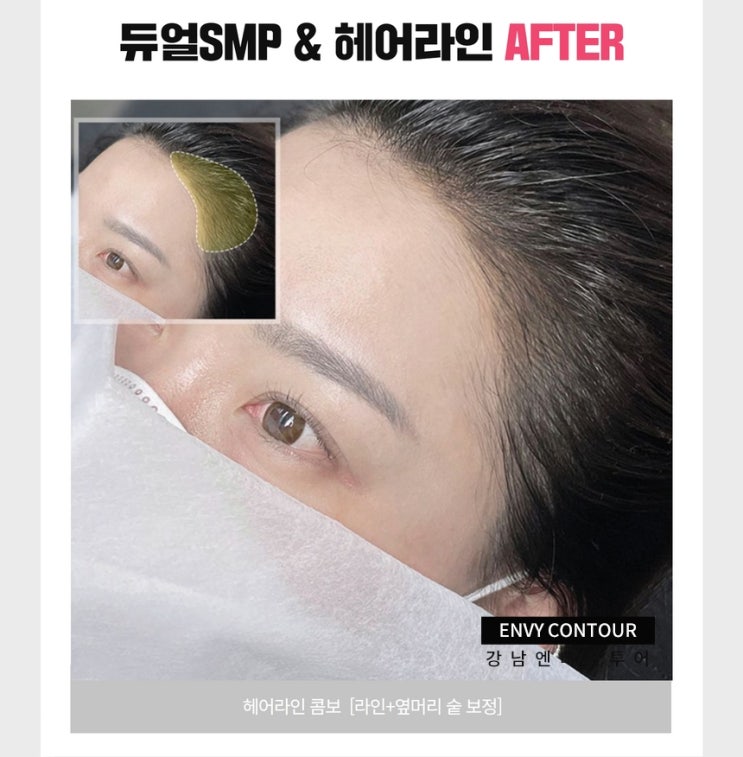  헤어라인문신 이제는 메디컬 타투로 받으세요
