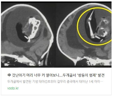 中 갓난아기 머리 너무 커 열어보니...두개골서 '쌍둥이 형제' 발견 中 갓난아기 머리 너무 커 열어보니...두개골서 '쌍둥이 형제' 발견