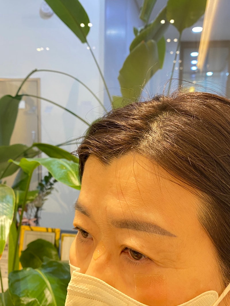 홍대피부과 이마필러 벨로테로 5Cc 후기 (전후, 붓기, 리터치, 몰딩) : 네이버 블로그
