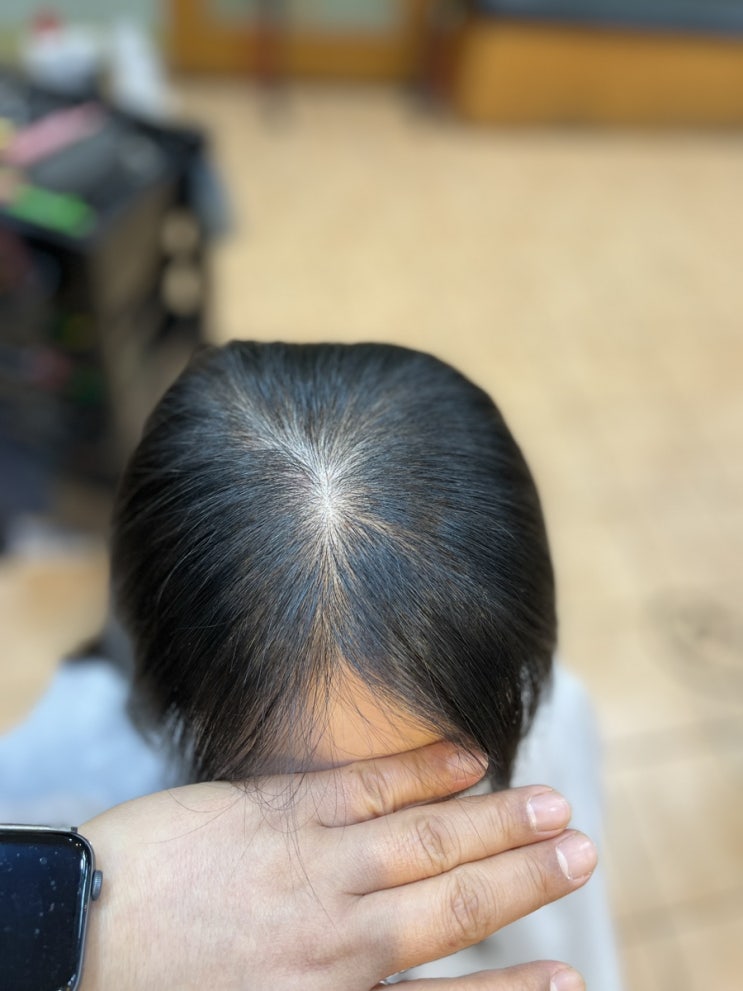  앞머리갈라지고 정수리 가마탈모 여자 탈모펌