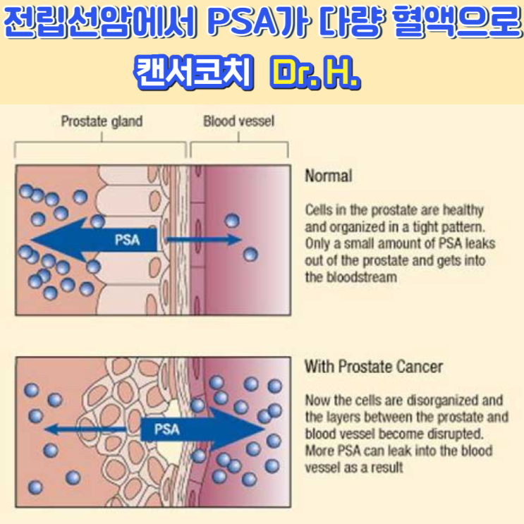 유리 전립선특이항원 비율(%free PSA, %fPSA) 전립선암진단검사
