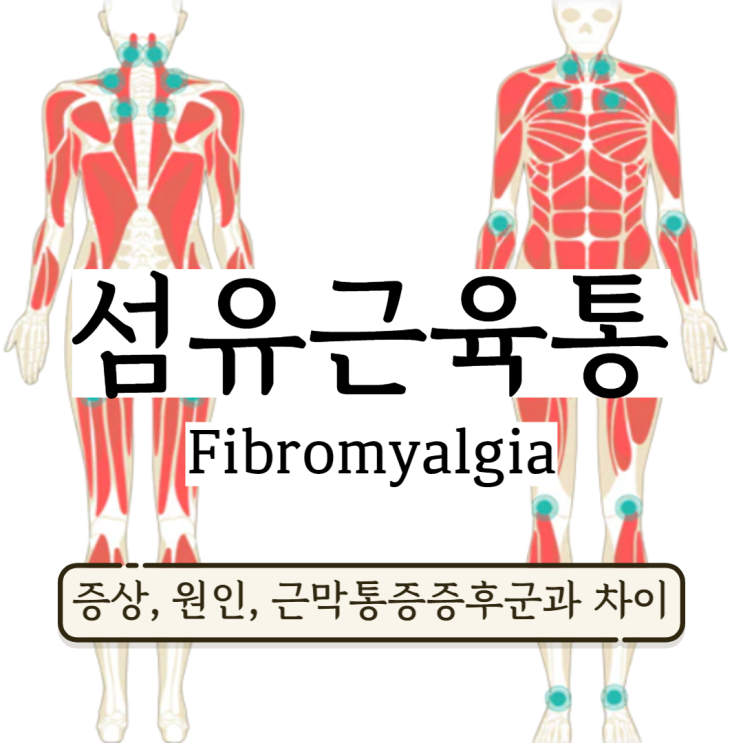 섬유근육통증상 원인 치료 검사 (근막통증증후군과 차이) 섬유근육통증상 원인 치료 검사 (근막통증증후군과 차이)