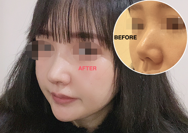  짧은코교정, 나에게 맞는 방법은?(서울성형외과 치유)