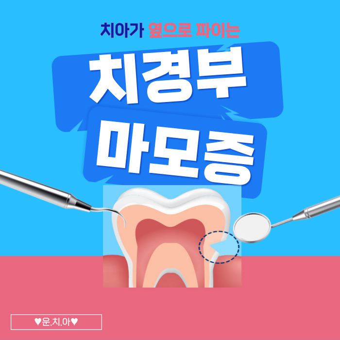  치경부마모증, 증상과 원인 치료법은?