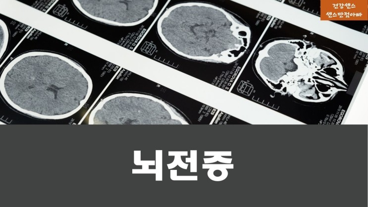 군대 뇌전증 원인 및 증상(전조증상) 예방법