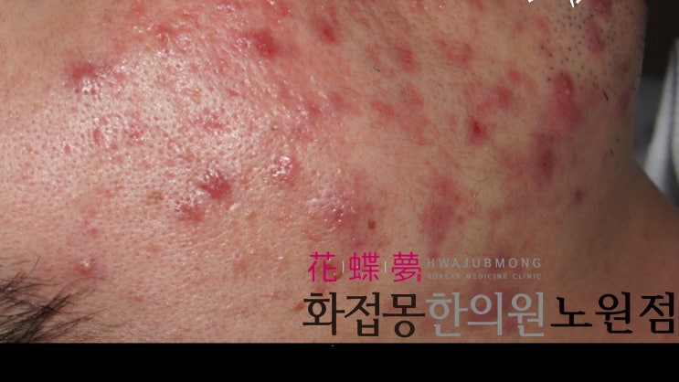  노원모낭염 피부과한의원 화접몽에서 해결해요