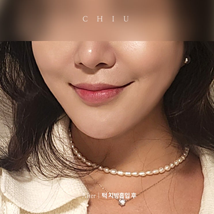  얼굴지방흡입(미루고 미뤘었는데.. 진작 할껄!!)이중턱흡입 후기!
