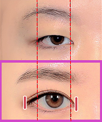 눈재수술후기/트임수술과 부분절개쌍꺼풀수술로 컴플렉스개선&lt;강남눈성형외과 치유&gt;