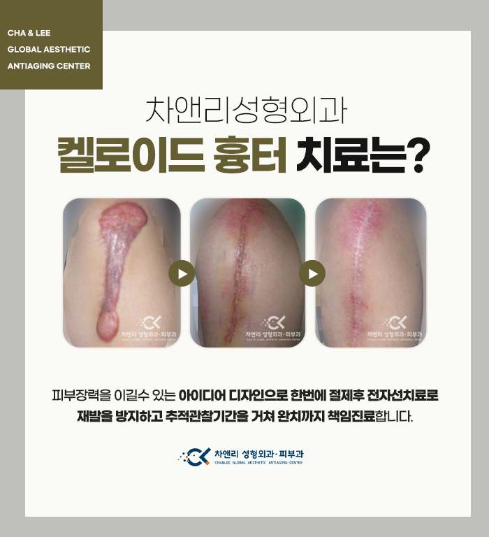  켈로이드치료 한번에 완치할 수 있습니다