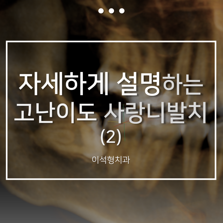  완전 매복 사랑니 발치 과정과 발치 후 감염 예방