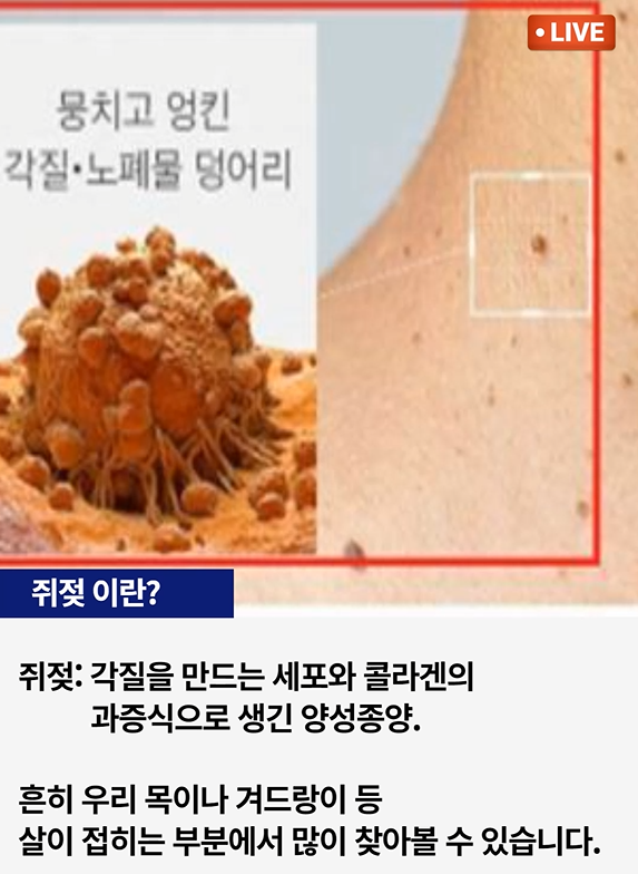 쥐젖 제거 제품, 정말 효과 있을까? : 네이버 블로그