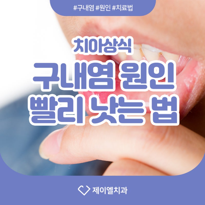 구내염의 원인과 빨리 낫는 방법을 알아보세요! 2