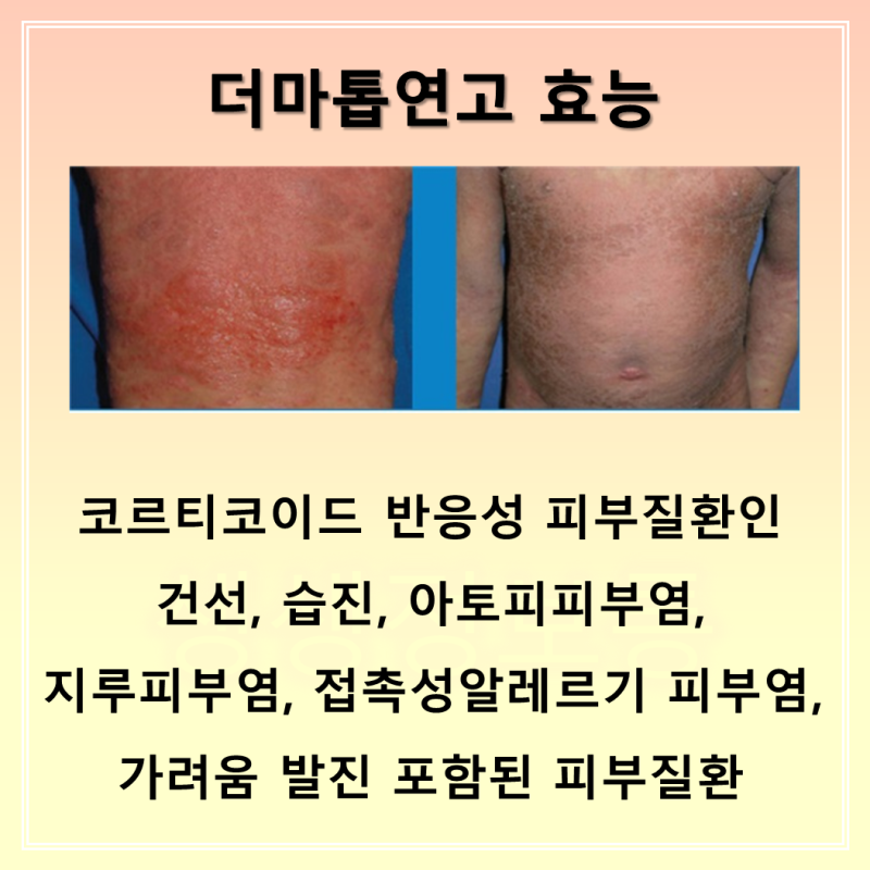더마톱 연고 크림 성분, 효능, 사용법 주의필요! : 네이버 블로그