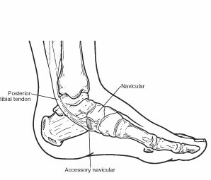 부주상골증후군 (accessory navicular syndrome) & 후경골건 기능 장애 (post. tibital tendon dysfunction)
