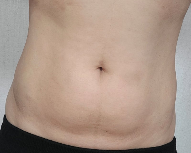2.5kg감량 후 복부지방용융주사 효과 7