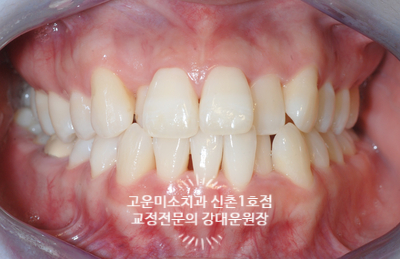  가위교합 돌출입 덧니 블랙트라이앵글 잇몸이 안 좋은 경우의 교정치료 신촌치과 교정전문의 강대운원장 고운미소신촌1호점 치료증례