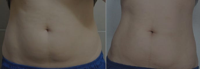 2.5kg감량 후 복부지방용융주사 효과 5