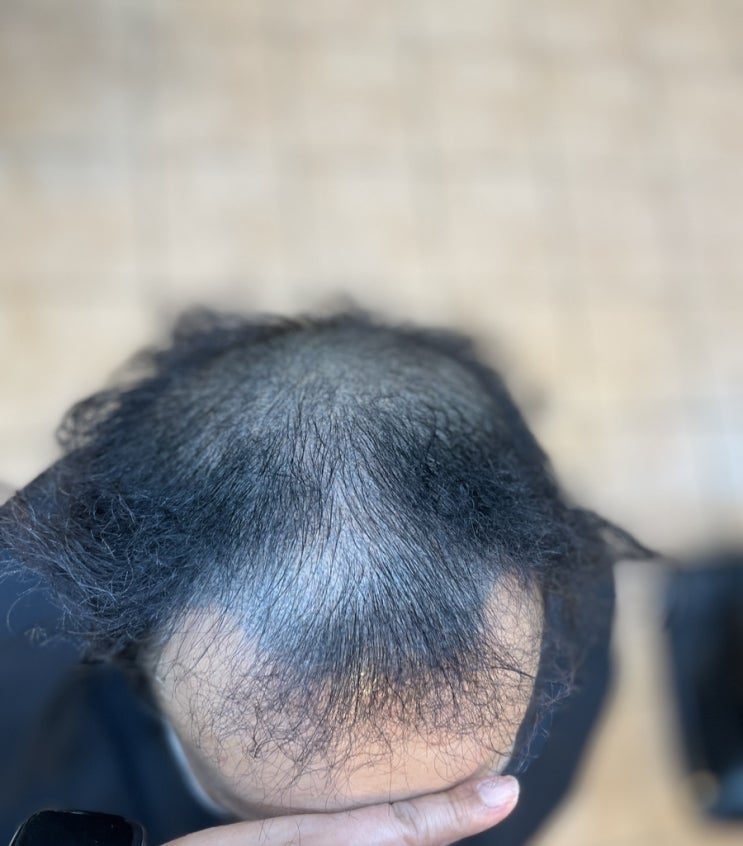  모발이식 두피문신 심한남자탈모 더 이상 물러설곳없다 노빠꾸 남자탈모펌