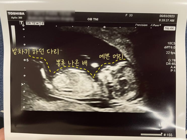  캐나다에서 임신 초기(~13주) 기록