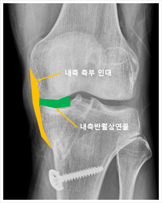  광주무릎통증, 원인 모르면 시간이 지나도 또 아픕니다.