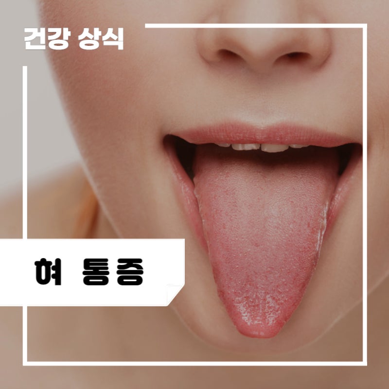 혀 통증 원인 5가지 및 혓바닥 통증 관리 방법 : 혀가 아파요(혀 끝, 옆, 밑, 안쪽, 뿌리) : 네이버 블로그