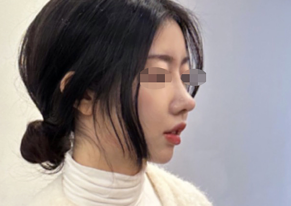  비중격 코끝성형 후 돼지코 안되는게 불편해요ㅠㅠ(성형외과)