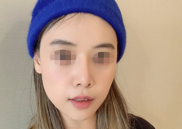  자가진피코수술 후, 너무 낮아졌어요ㅠㅠ실리콘으로 코재수술 가능한가요???