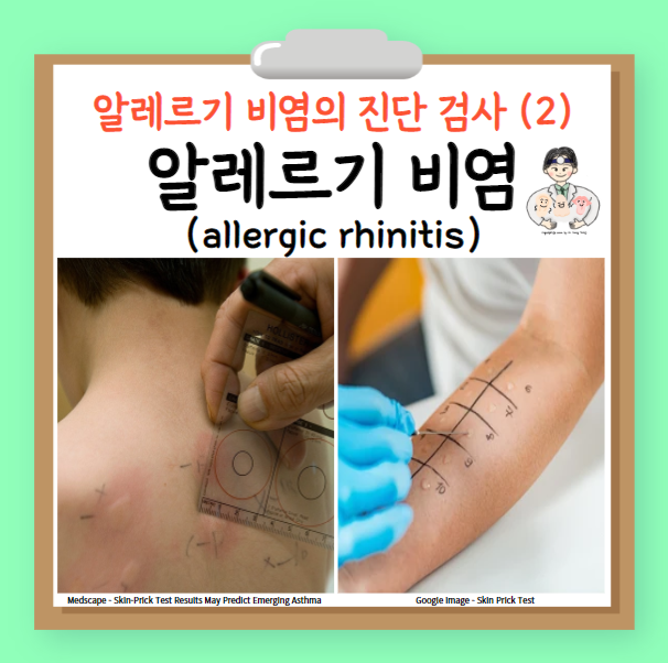  환절기 알레르기 (3) - 알레르기 비염 (allergic rhinitis)의 진단 검사 피부반응검사, 유발검사
