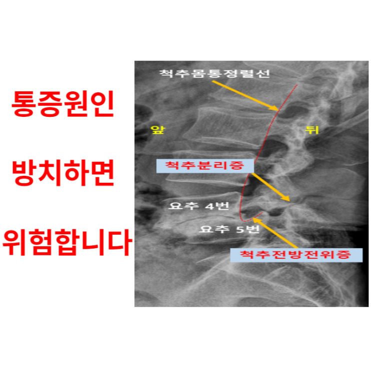  광주허리디스크, 통증 원인 모른 채 방치하면 위험합니다