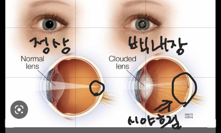  백내장