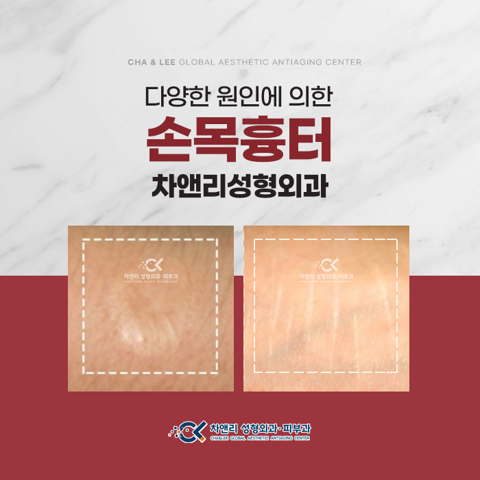  타인의 시선이 머물게 하는 손목흉터