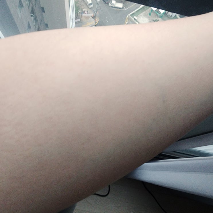  환절기 피부 가려움증상 해결하는 방법은