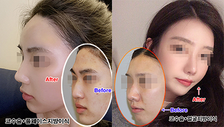  코수술,풀페이스지방이식 / 중요한 포인트,TIP! <코지방이식후기 , 강남코지방이식잘하는곳에서>