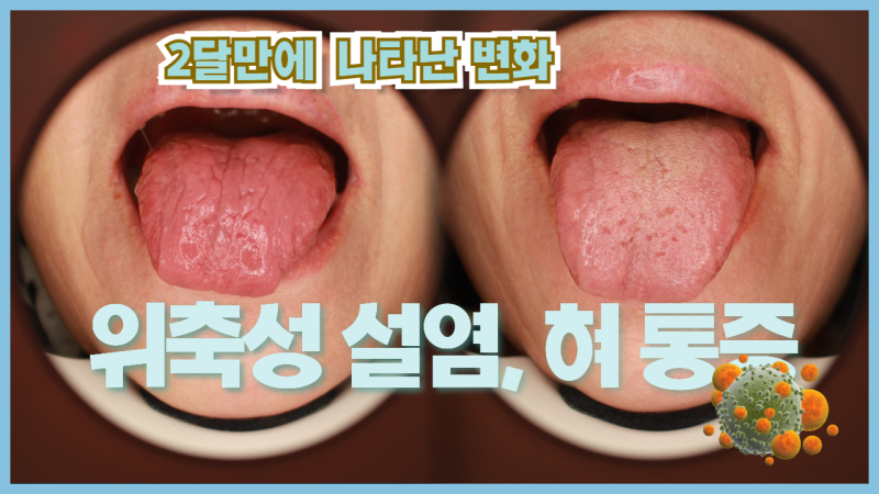 위축성 설염 - 혀 통증 입맛이 없는 이유 그 원인은