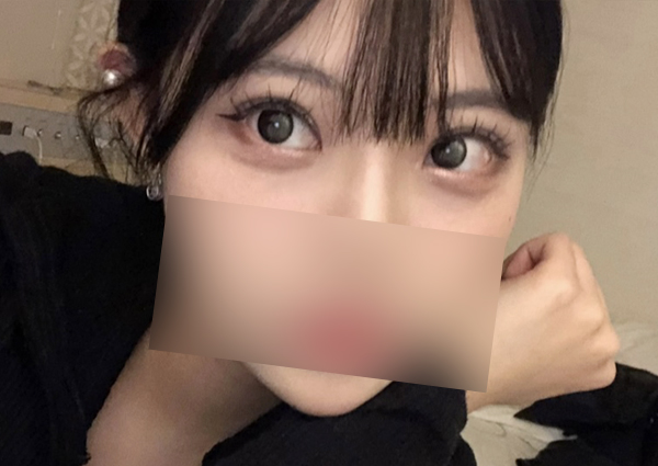  쌍꺼풀재수술 시기(매몰 2달 차,, 라인이 너무 높아요ㅠㅠ)
