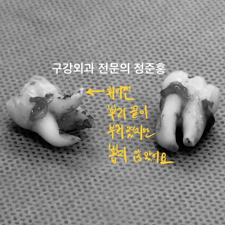  이를 뽑다가 뿌리가 부러졌어요. 뿌리를 남겨도 괜찮나요?