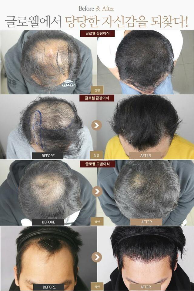  탈모 고민! 글로웰 끝장이식으로 해결하세요