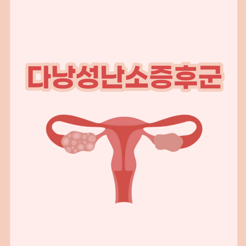 다낭성난소증후군에 대한 모든 것! 어떤 한약과 영양제가 도움될까?