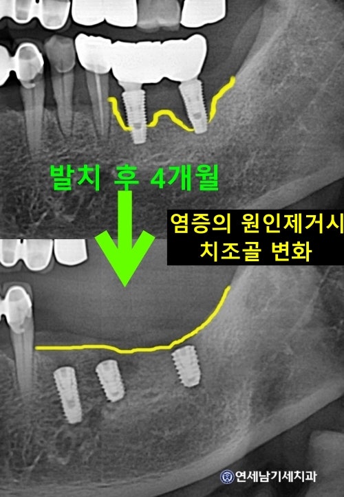 잇몸뼈이식 심사기준