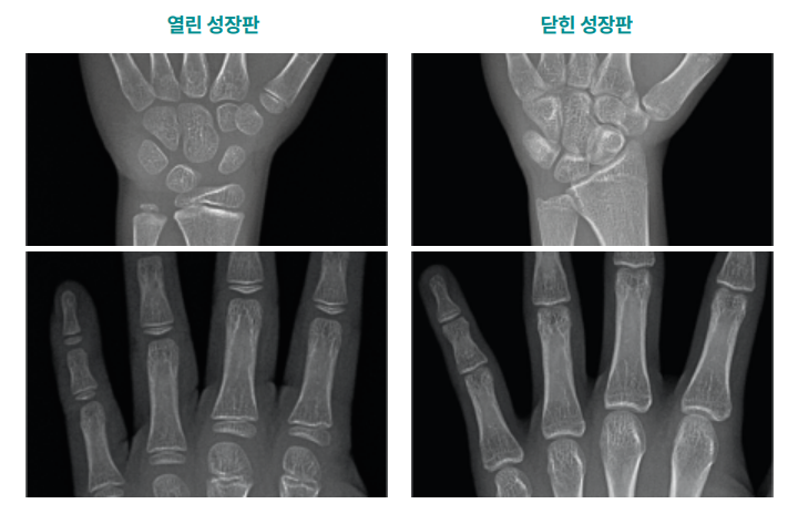 치과에서 확인할 수 있는 성조숙증, 성조숙증과 관련한 교정 이야기 치과에서 확인할 수 있는 성조숙증, 성조숙증과 관련한 교정 이야기