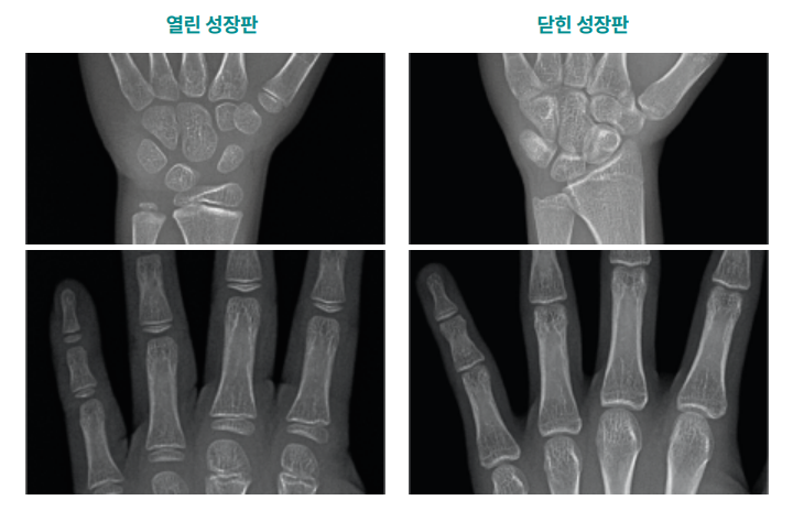 치과에서 확인할 수 있는 성조숙증, 성조숙증과 관련한 교정 이야기