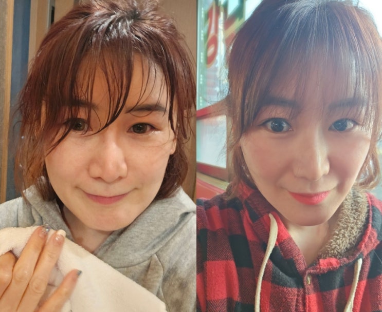  턱선 피부리프팅 얼굴 브이라인 실리프팅 종류 효과 멍 통증 붓기 후기
