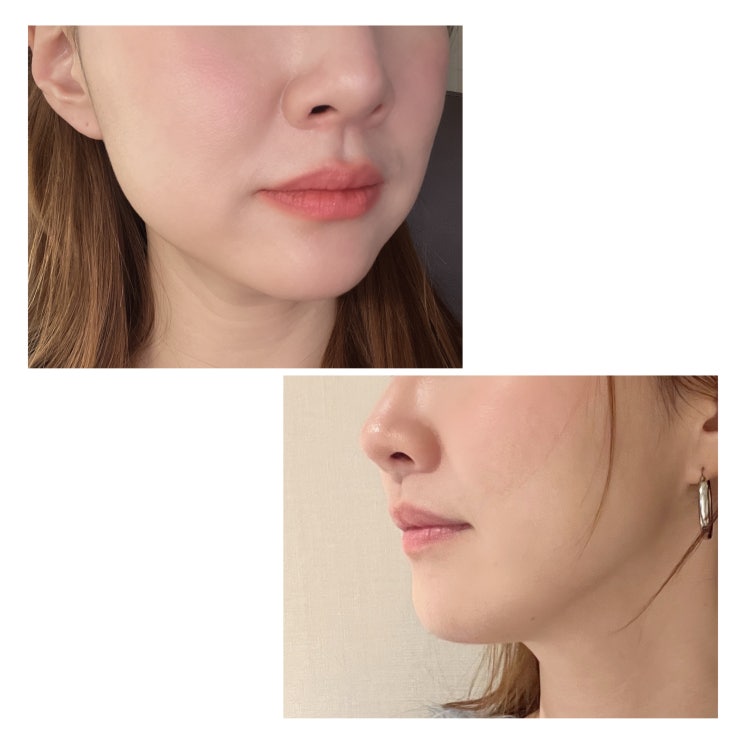 슈링크 후기 얼굴 리프팅 시술 효과 주기 + 코조각주사 한달차