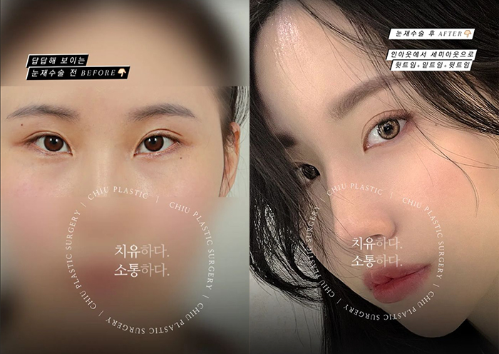  눈재수술 후, 확 틔어진 눈매(강남성형외과 치유)