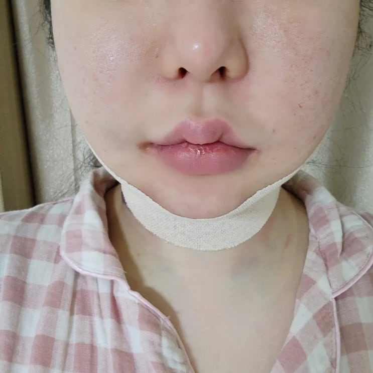  프레쉬성형외과 얼굴지방흡입(이중턱,귀밑) 당일부터 한달차 멍붓기