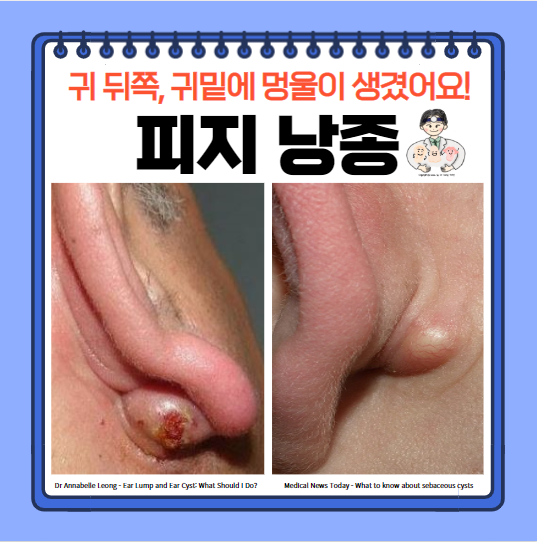  귀 뒤 멍울, 귀밑 멍울 - 피지 낭종 원인 증상 치료 수술